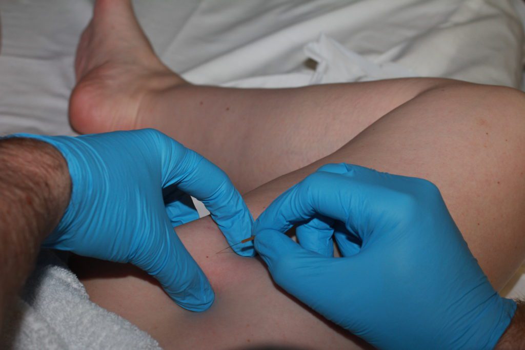 Dry Needling of the Adductor Longus Muscle