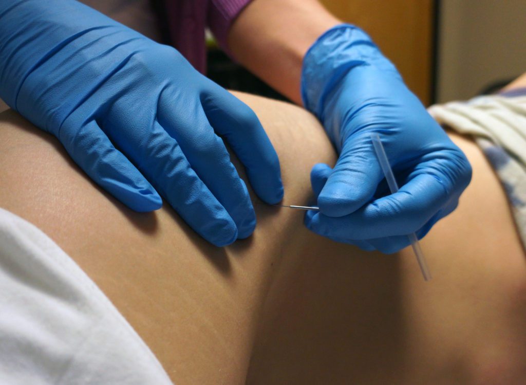 Dry Needling of the Tensor Fascia Latae muscle