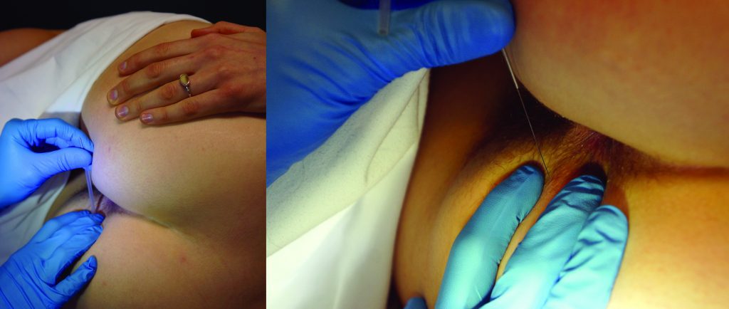 Pelvic Floor Dry Needling For The Non Pelvic Floor Therapist