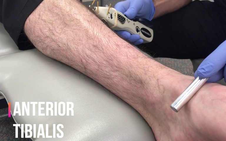 COMBINING TECHNIQUES: GRASTON AND FUNCTIONAL DRY NEEDLING +E-STIM