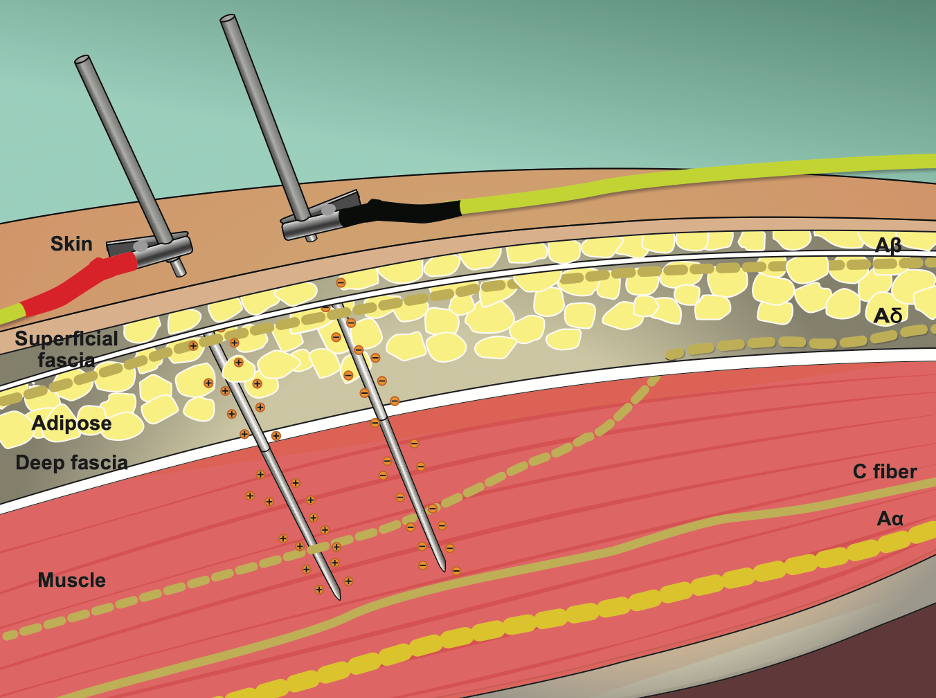 Transcutaneous electrical nerve stimulation (TENS) setup. (a) schematic