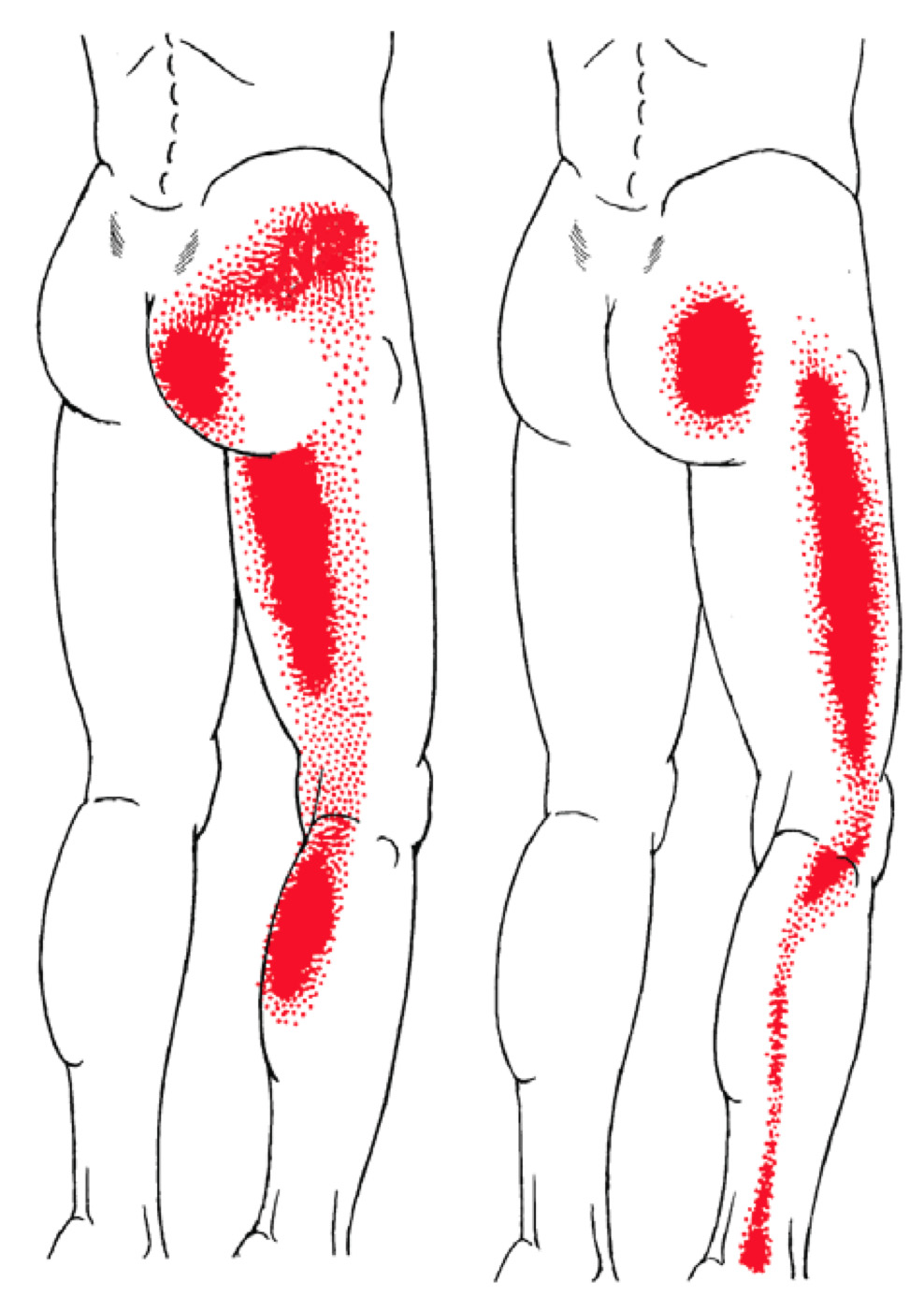 Dry Needling in Chiropractic - Myopain Seminars